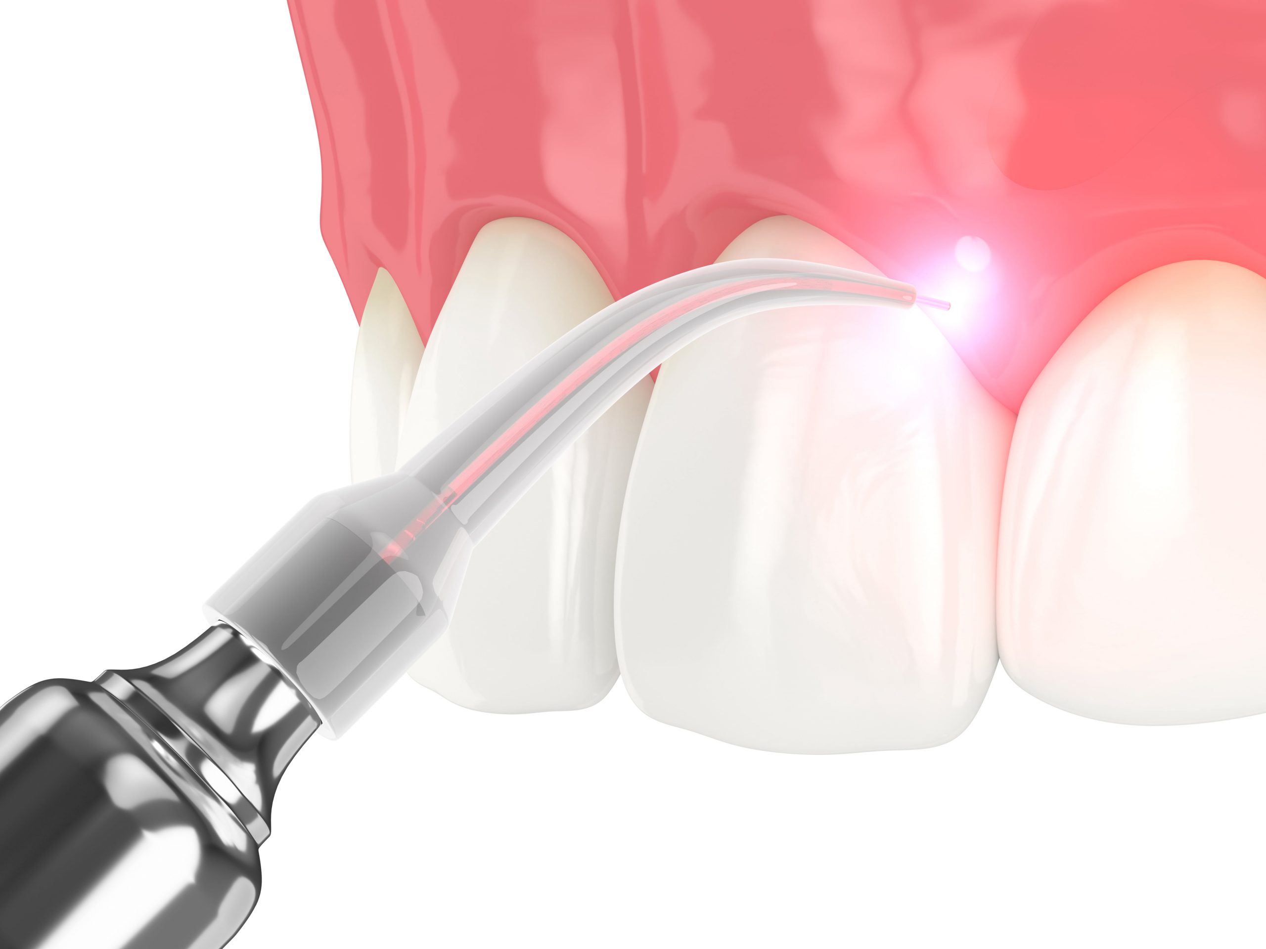 Benefits Of Laser Dentistry Torrey Hills Dental