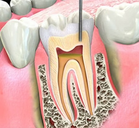 Endodontics in Carmel Valley, San Diego