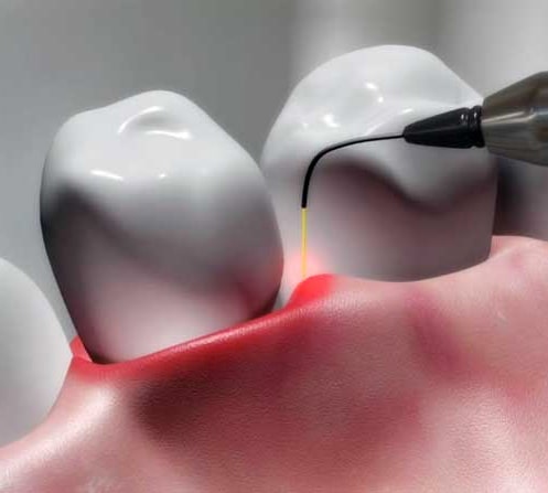 Laser Dentistry in Carmel Valley