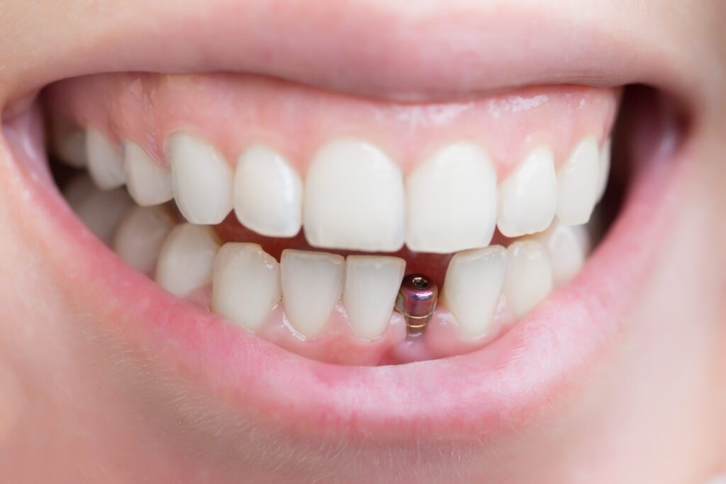 Are You a Candidate for Single Tooth Implants? Screening and Evaluation