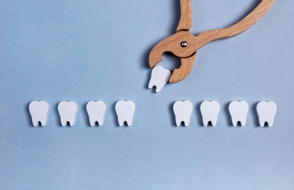 What are the Benefits of Wisdom Teeth Removal?