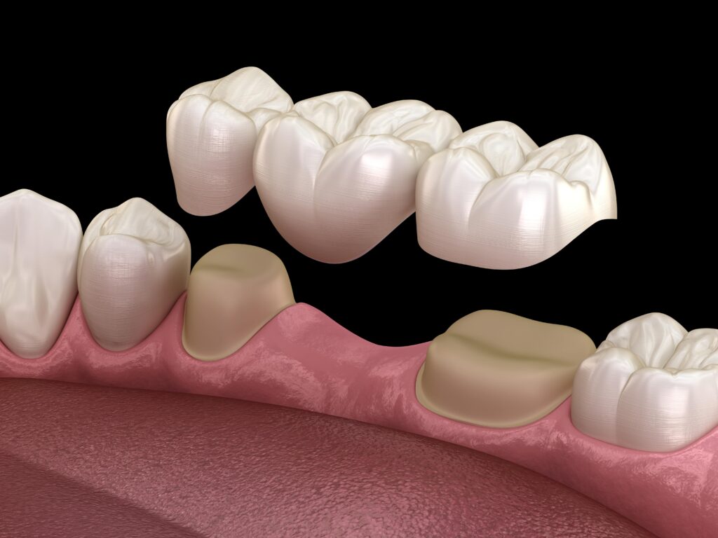 How a Dental Bridge Can Restore Your Smile