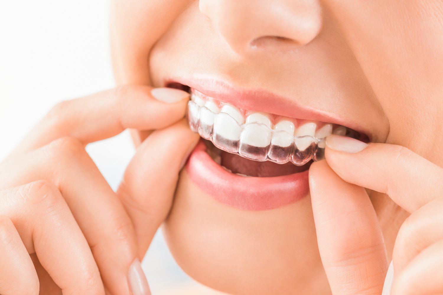 Invisalign is the “Clear Choice” for Straightening the Smile!