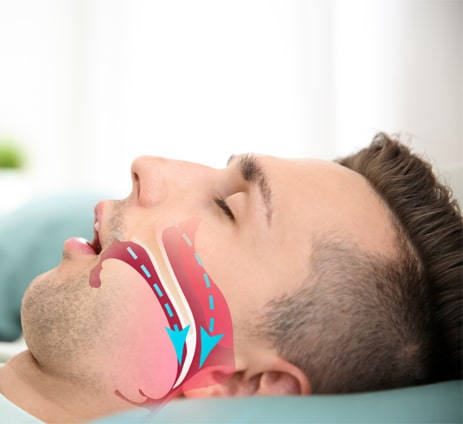 Risk factors for sleep apnea