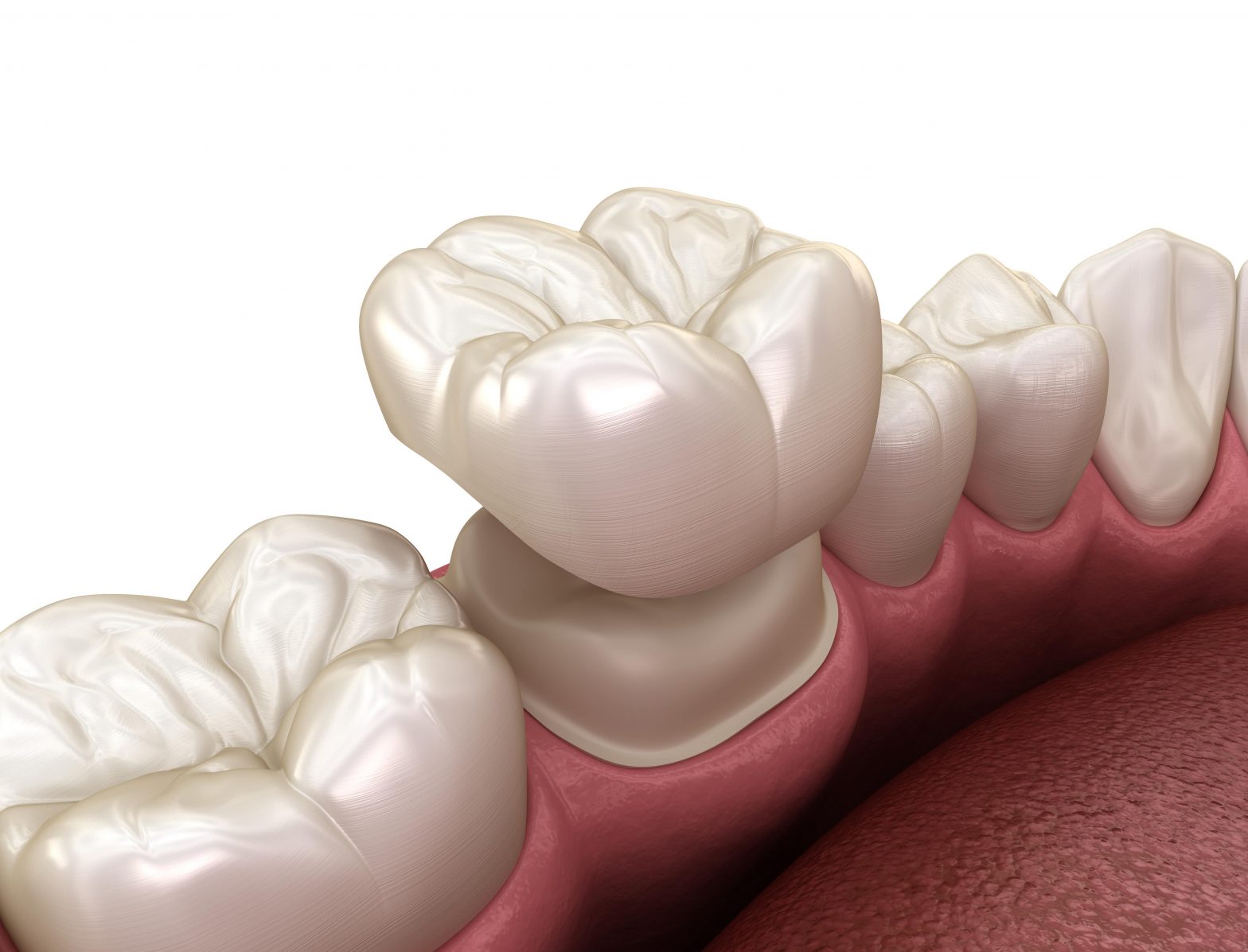 Same-Day Dental Crowns At Torrey Hills Dental